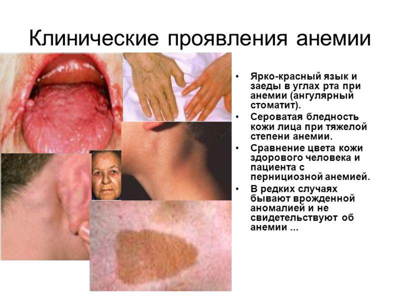 Симптомы анемии